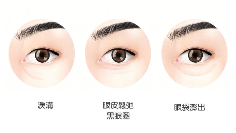 黑眼圈vs淚溝有什麼不同？